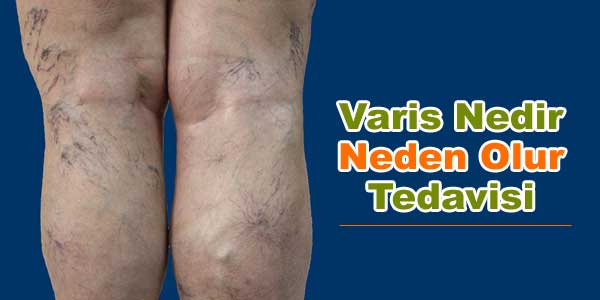varis nedir