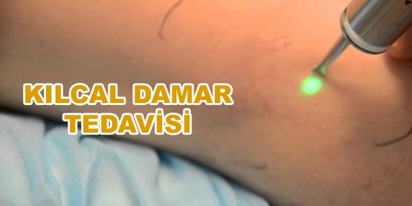 kılcal damar tedavisi