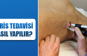 varis tedavisi nasıl yapılır