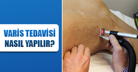 varis tedavisi nasıl yapılır