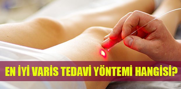 en iyi varis tedavisi